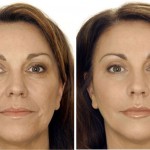 Botox-ein Nervengift macht Karriere