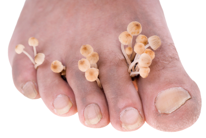 Vorbeugung gegen Fußpilz – Was tun gegen Fußpilz?