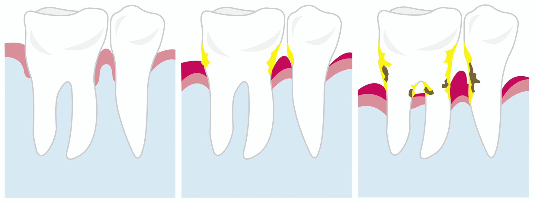 Wie entsteht Parodontitis