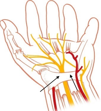Was sind die Ursachen für die Entstehung eines Karpaltunnelsyndroms?