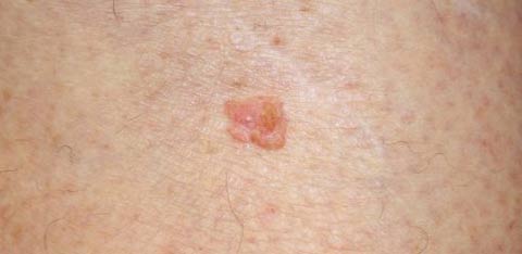 Haut, Hautkrebs: Diagnose mit Laser
