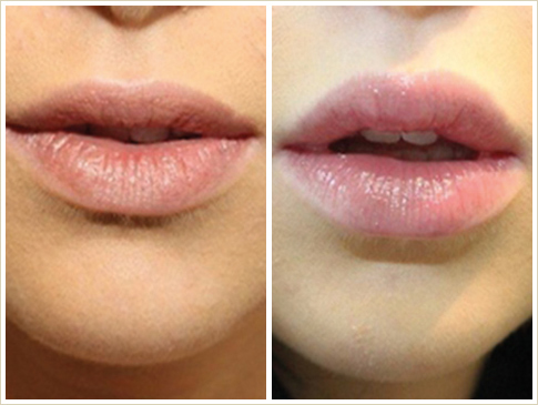 Lippenformung bei Dr. Galla – der Weg zum schönen Mund