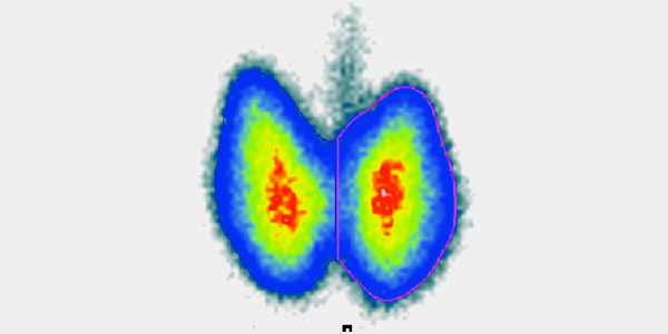 Mit der Schilddrüsenszintigraphie heiße und kalte Knoten erkennen