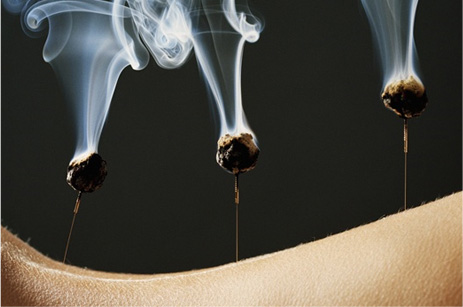 Moxibustion