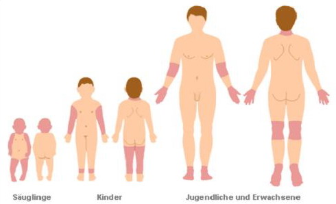 Ursachen und Therapie von Neurodermitis