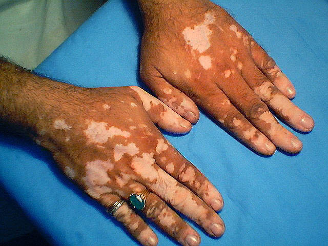 Vitiligo, Weißfleckenkrankheit: Aenderung moeglich, aber Krankenkassen zahlen nicht
