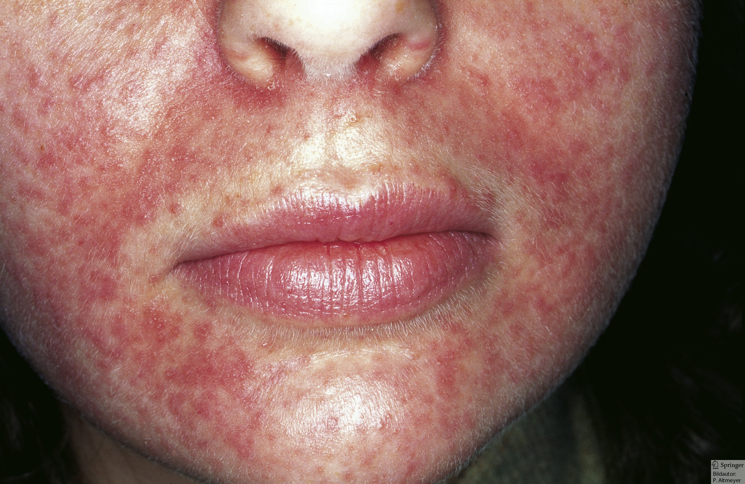 Hautkrankheiten Mundrose Periorale Dermatitis Ursachen